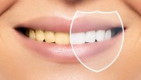 Ankara Diş Beyazlatma Tedavisi